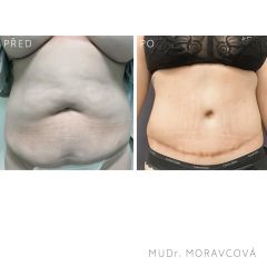 Abdominoplastika - MUDr. Petra Moravcová