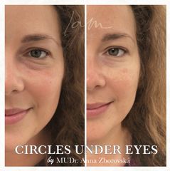 Odstranění kruhů pod očima - I am Clinic