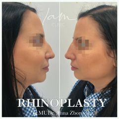 Rhinoplastika - I am Clinic