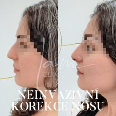 Nechirurgická korekce nosu - I am clinic