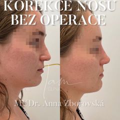 Nechirurgická korekce nosu - I am Clinic