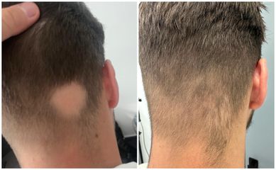 Vlasová mezoterapie - Rajská Clinic