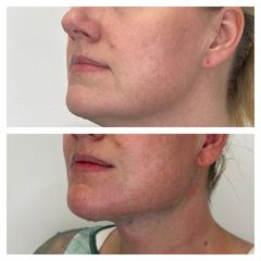 Neinvazivní lifting obličeje - Rajská Clinic