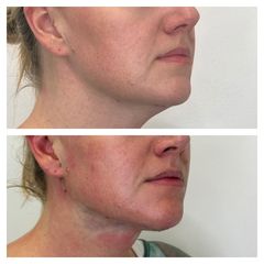Neinvazivní lifting obličeje - Rajská Clinic