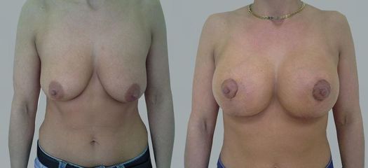 Modelace s augmentací - OB Care