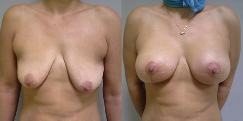 Modelace prsou s augmentací - OB Care