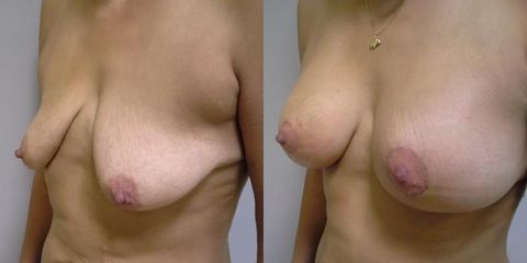 Modelace s augmentací - OB Care