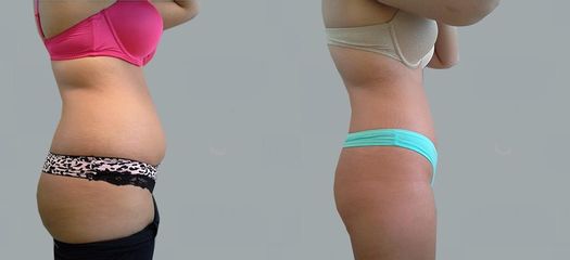 Liposukce břicha - OB Care