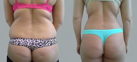 Liposukce - OB Care