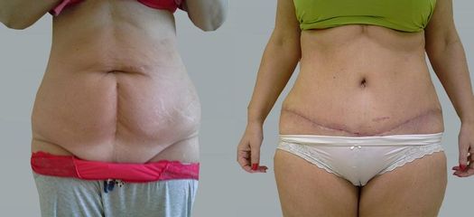 Abdominoplastika - OB Care
