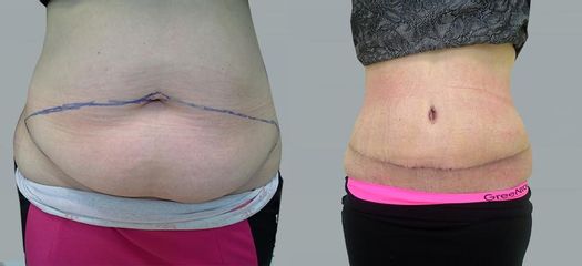 Abdominoplastika - OB Care