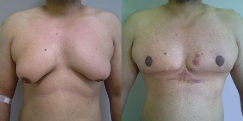 Odstranění gynekomastie - OB Care