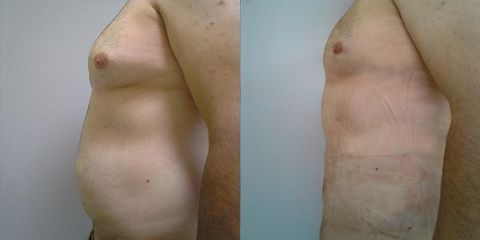 Liposukce břicha - OB Care