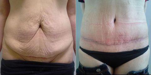 Abdominoplastika