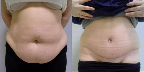Abdominoplastika