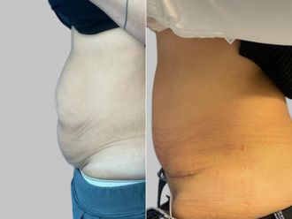 Abdominoplastika před a po - 867679