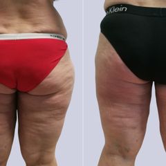 Liposukce stehen