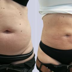 Liposukce břicha