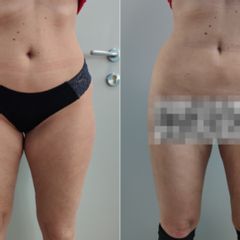 Liposukce boků a stehen