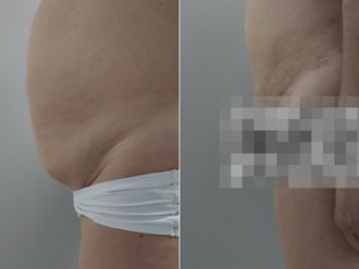 Liposukce před a po - 873408