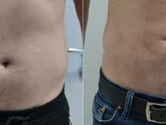 Liposukce před a po - 873409
