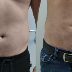 Liposukce břicha a boků