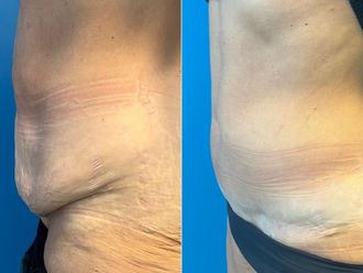Abdominoplastika před a po - 877225