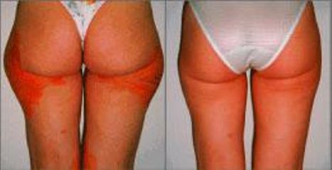 lipo pred
