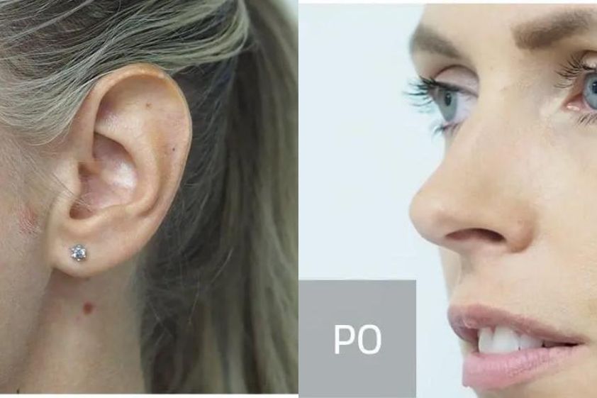 Microneedling před a po - 726477