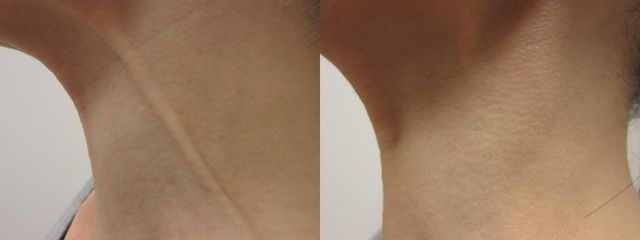 botulotoxin před