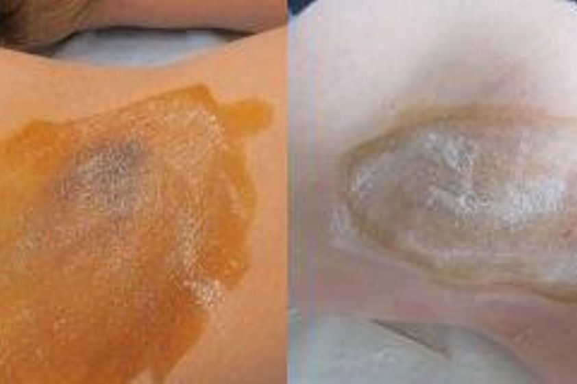Botulotoxin proti pocení před a po - 731201
