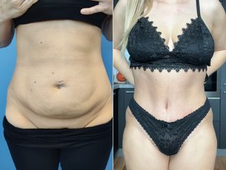 Abdominoplastika před a po - 867686