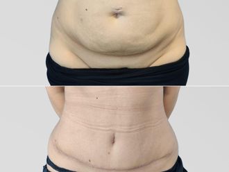 Abdominoplastika před a po - 868548