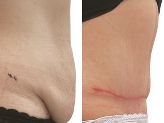 Abdominoplastika před a po - 880911