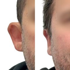 Plastická operace uší, tzv. otoplastika - MUDr. Boris Jegorov