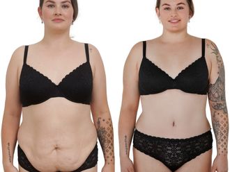 Abdominoplastika před a po - 880921