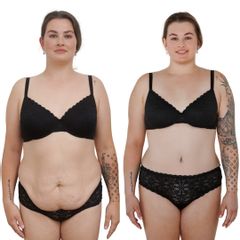 Plastická operace břicha, tzv. abdominoplastika - MUDr. Boris Jegorov