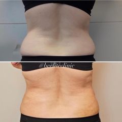 Liposukce - BE ELITE CLINIC