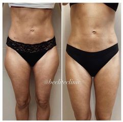 Liposukce - BE ELITE CLINIC