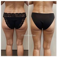 Liposukce - BE ELITE CLINIC