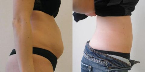 Liposukce břicha