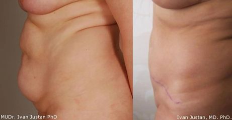 Abdominoplastika