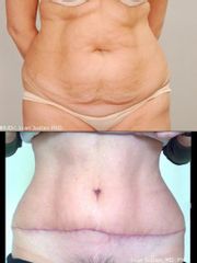 Abdominoplastika