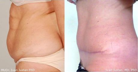 Abdominoplastika