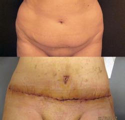 Abdominoplastika