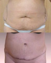 Abdominoplastika