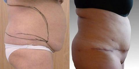 Abdominoplastika