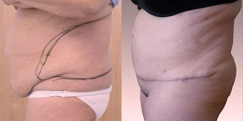 Abdominoplastika