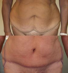 Abdominoplastika