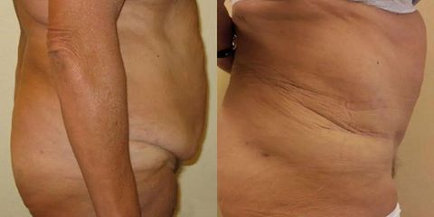 Abdominoplastika